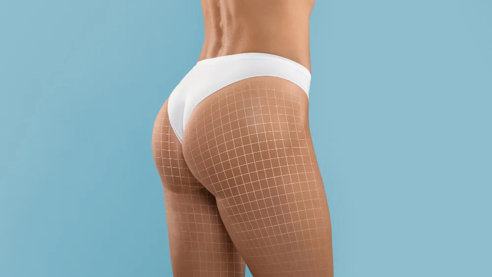 Liposukce hýždí – modelace tvaru hýždí