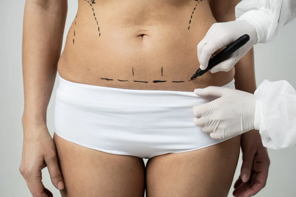 Tummy Tuck (Abdominoplasty): What It Really Involves and What to Expect