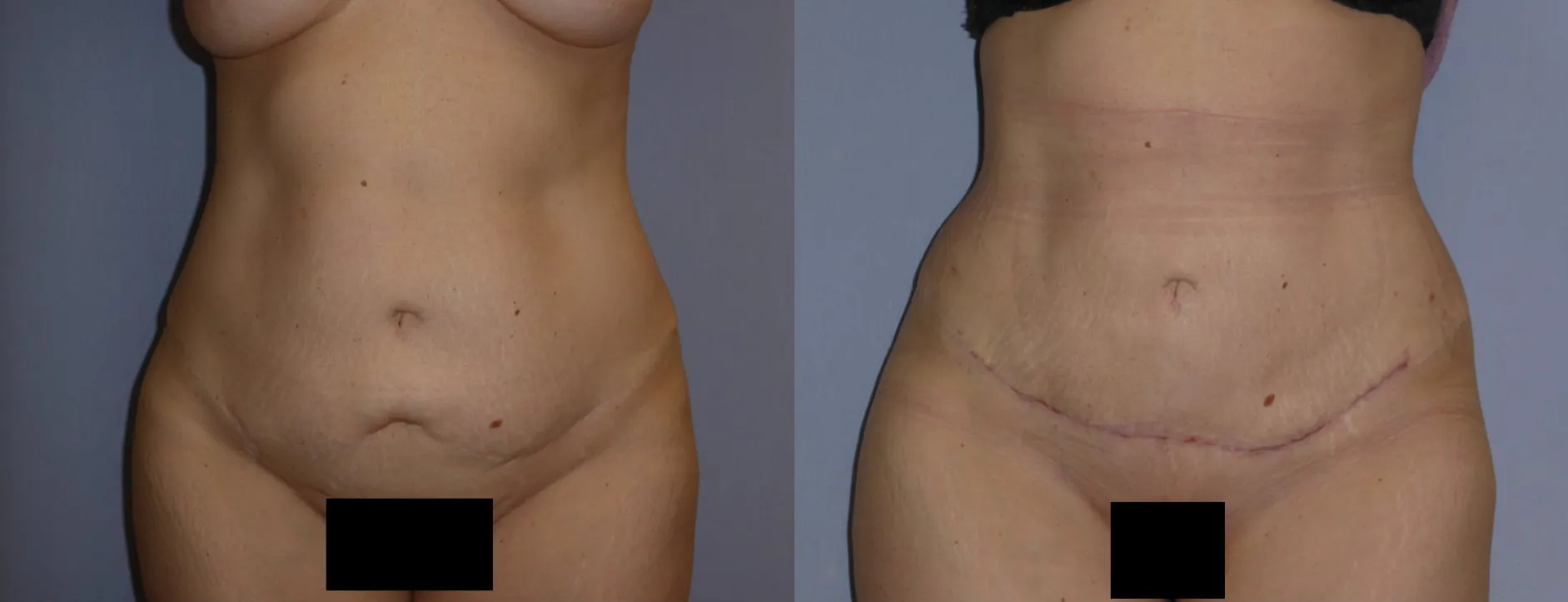 Абдомінопластика – результат 1