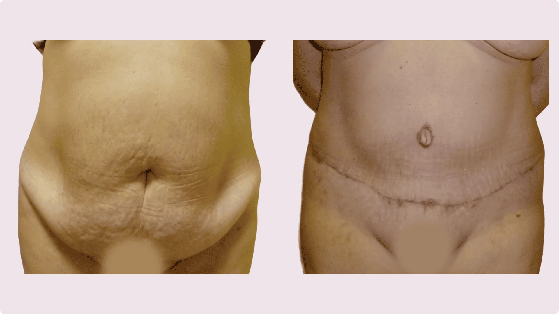 Abdominoplasty – before and after photo 1