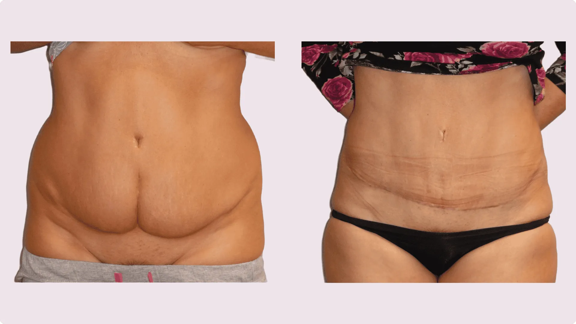 Bauchstraffung – Abdominoplastik – Vorher-Nachher-Foto 4