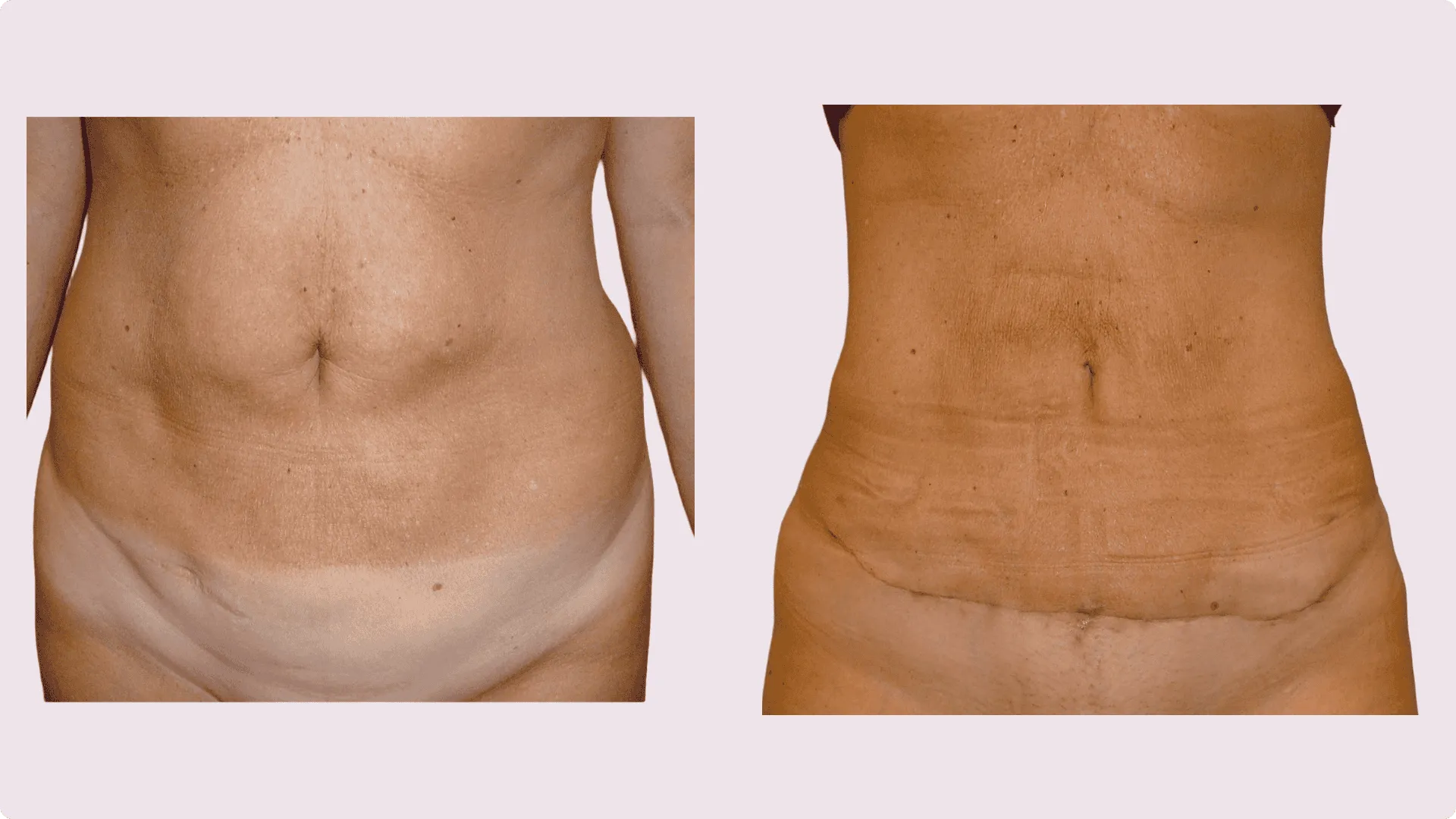 Abdominoplasty – before and after photo 2