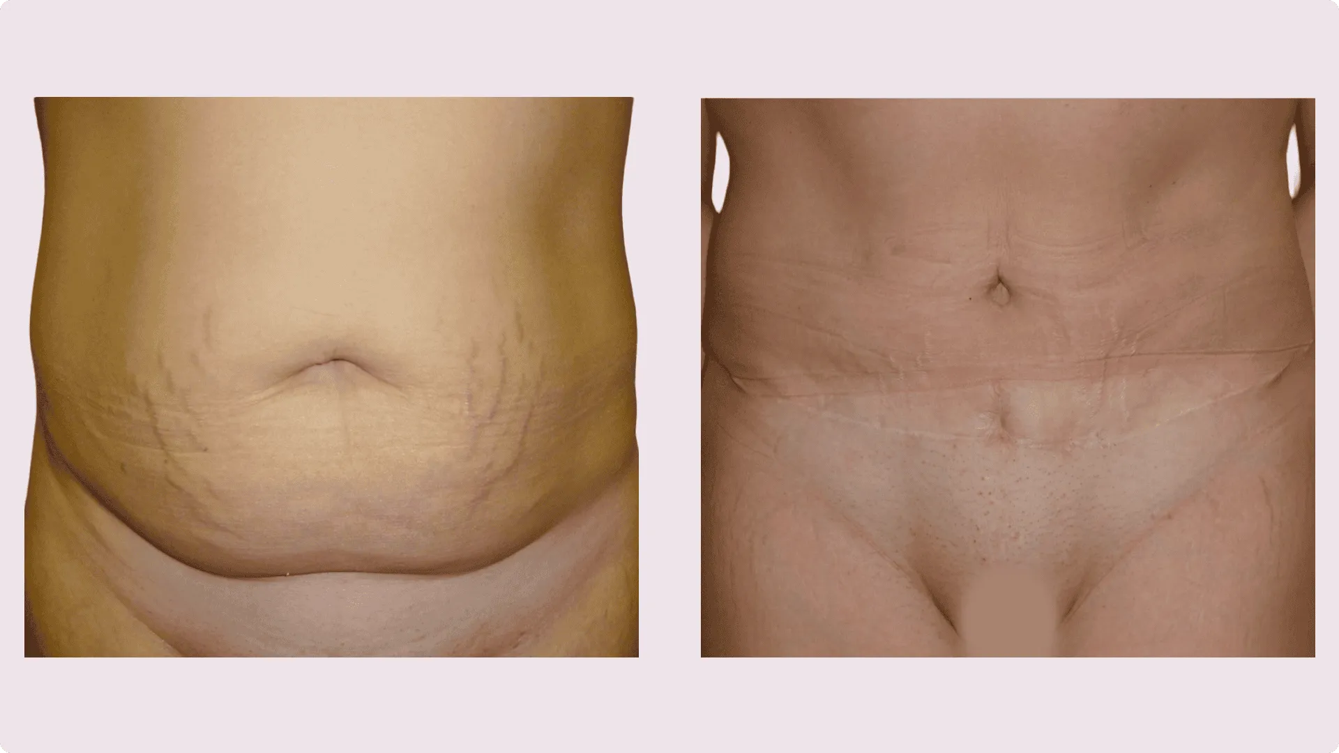 Bauchstraffung – Abdominoplastik – Vorher-Nachher-Foto 5