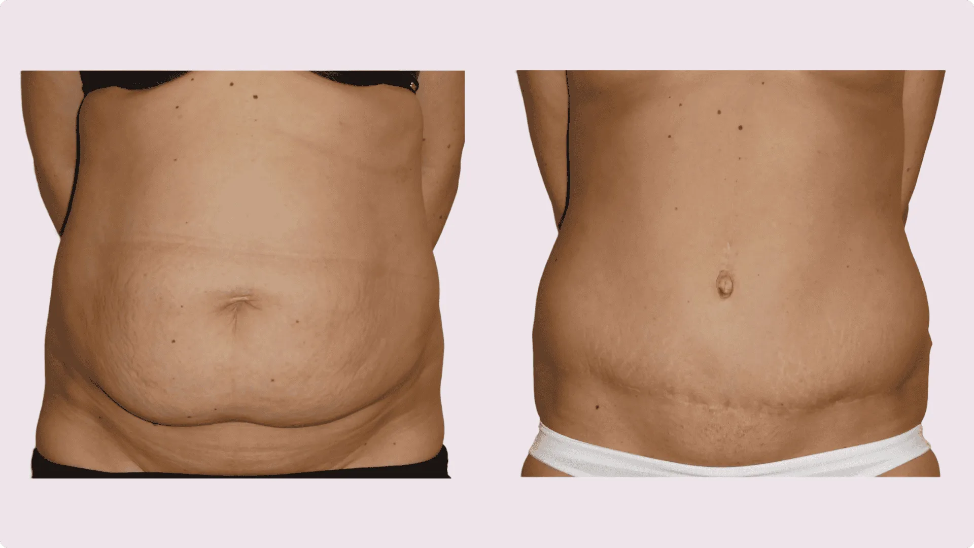 Abdominoplasty – before and after photo 3