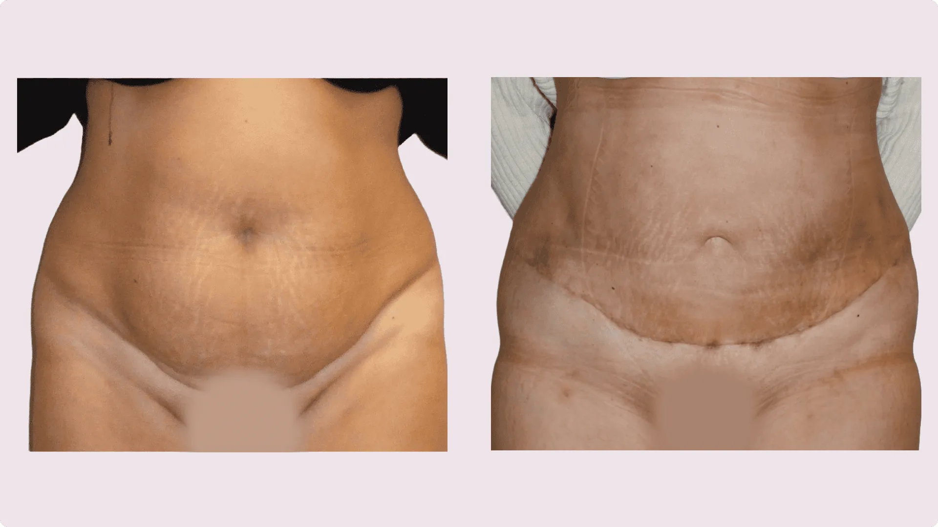 Bauchstraffung – Abdominoplastik – Vorher-Nachher-Foto 6