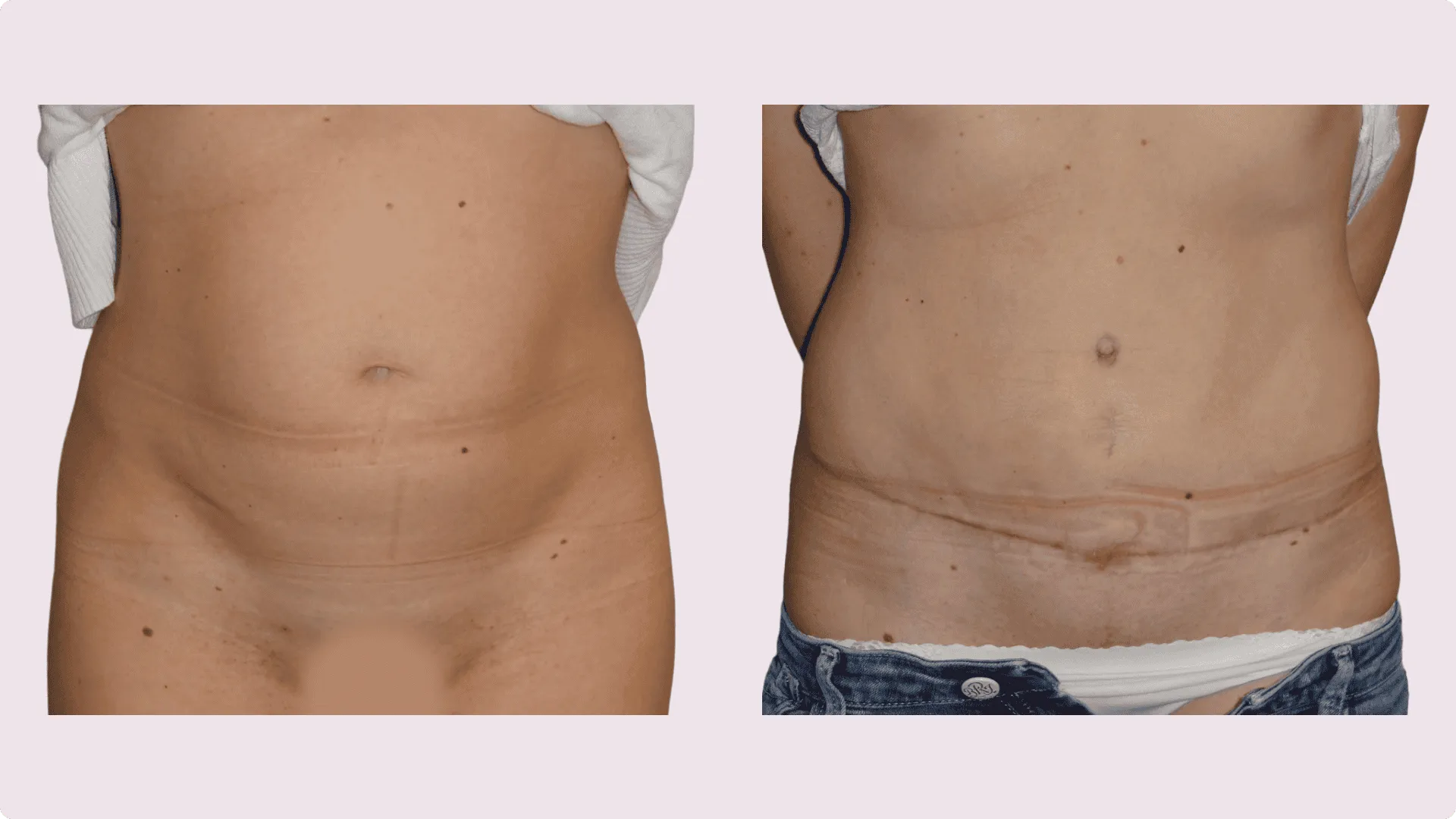 Abdominoplasty – before and after photo 4