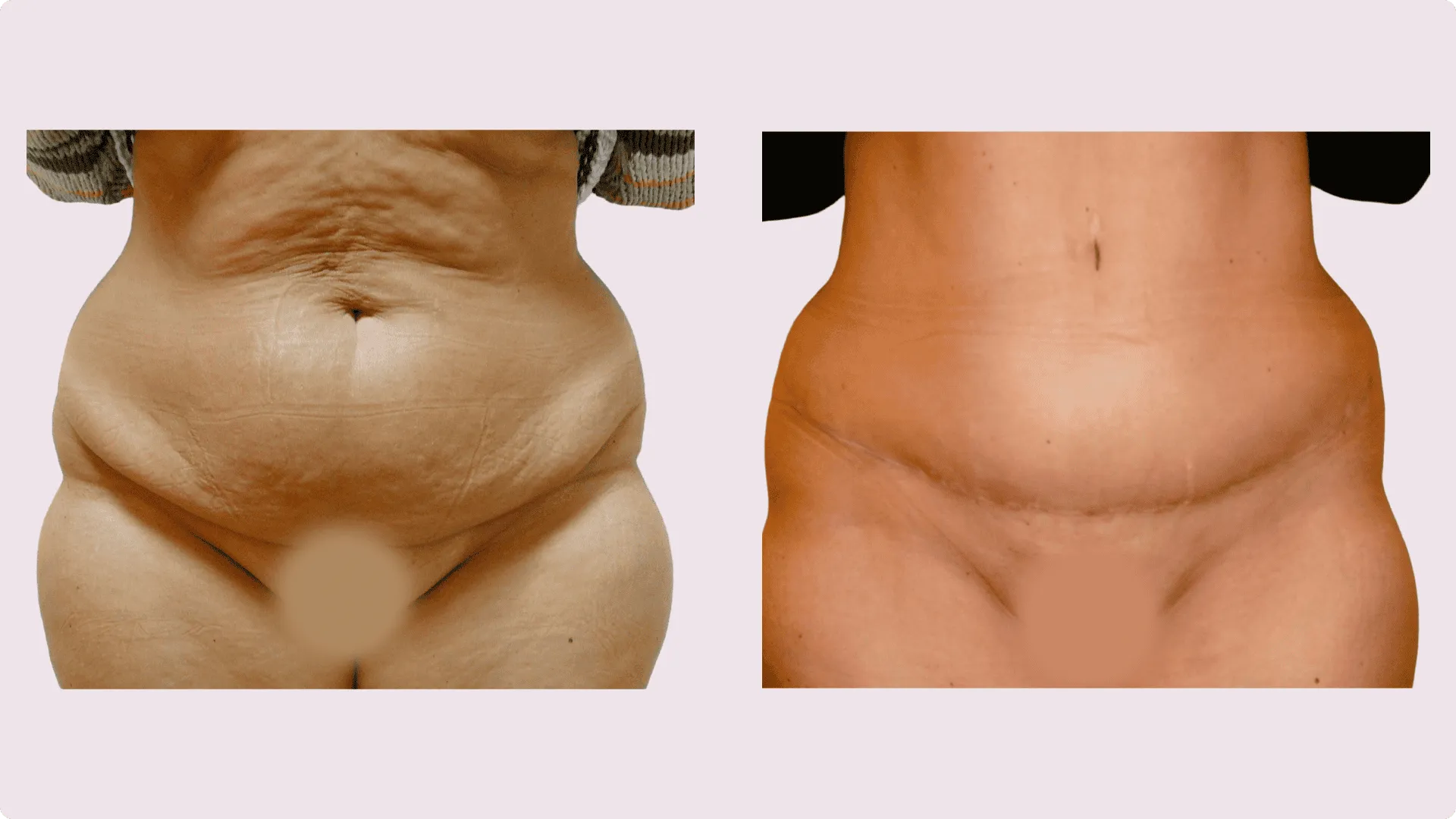 Tummy Tuck – Abdominoplasty – before and after photo 5
