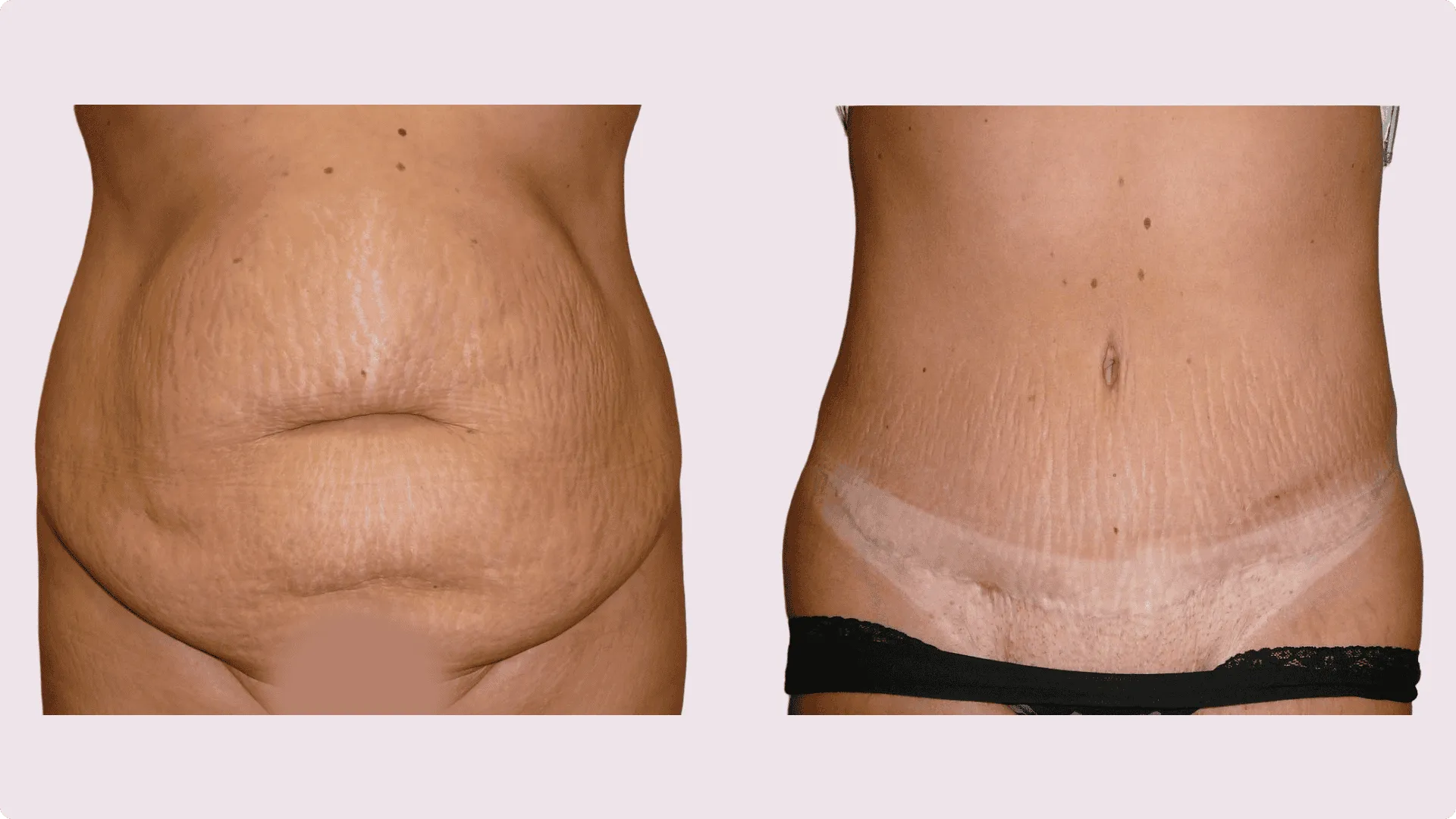 Abdominoplasty – before and after photo 5