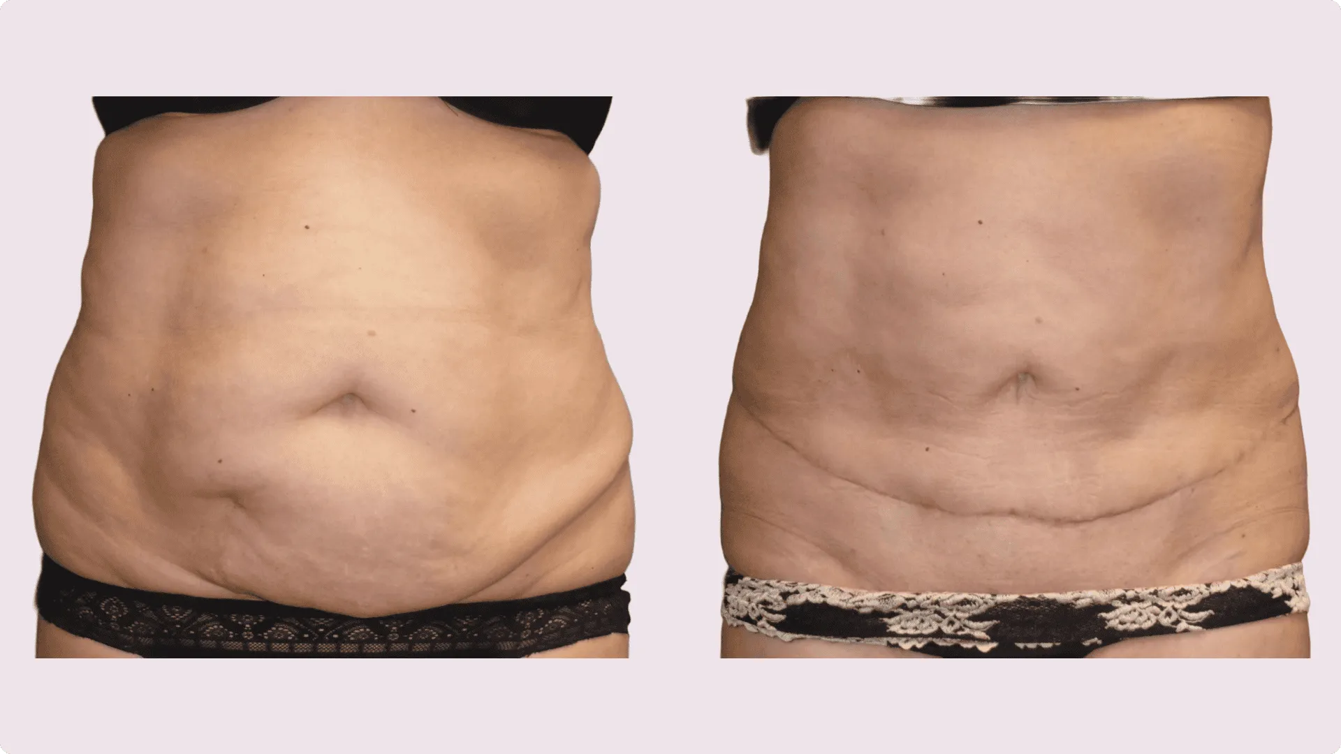 Tummy Tuck – Abdominoplasty – before and after photo 7