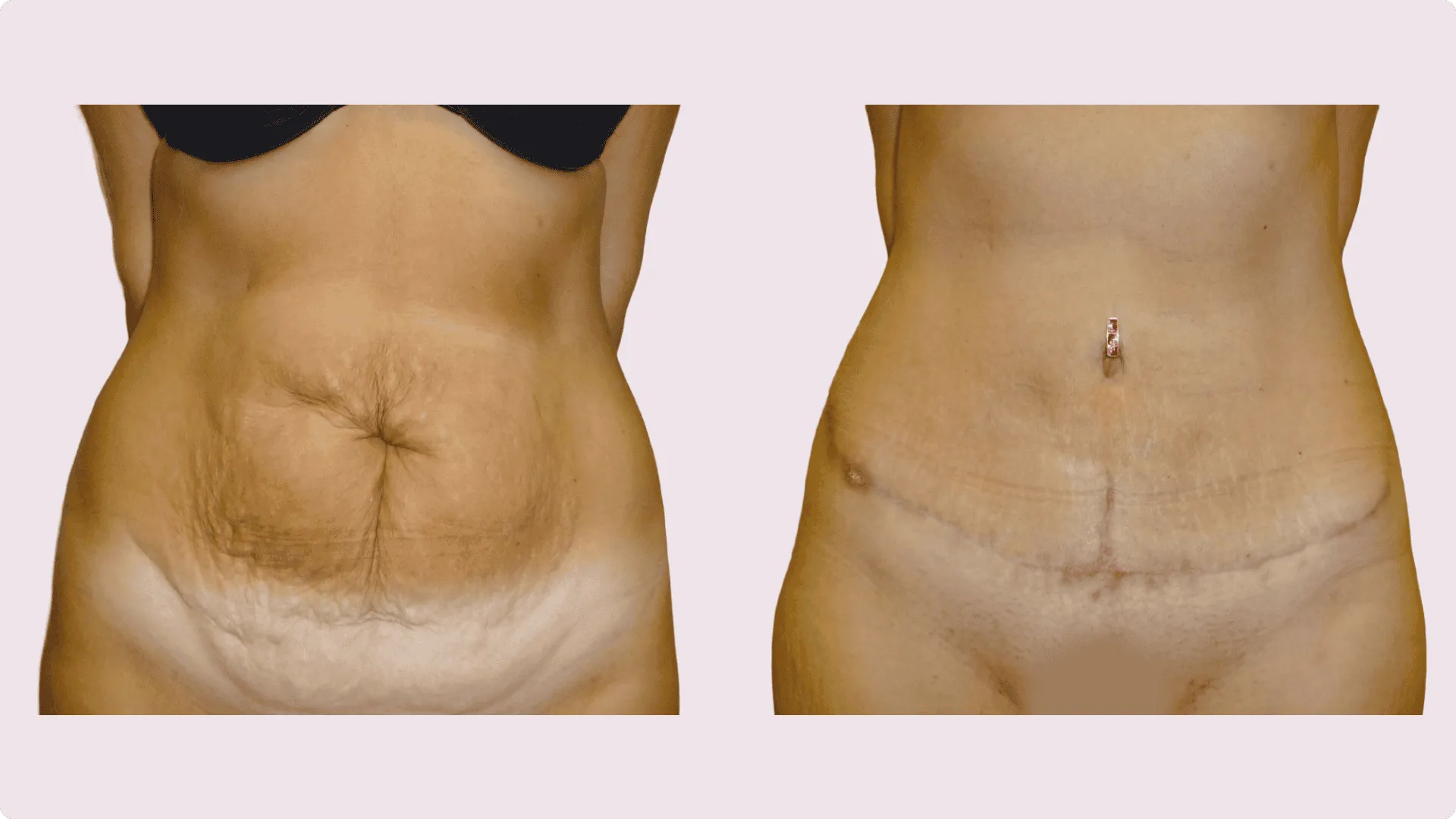 Abdominoplasty – before and after photo 6