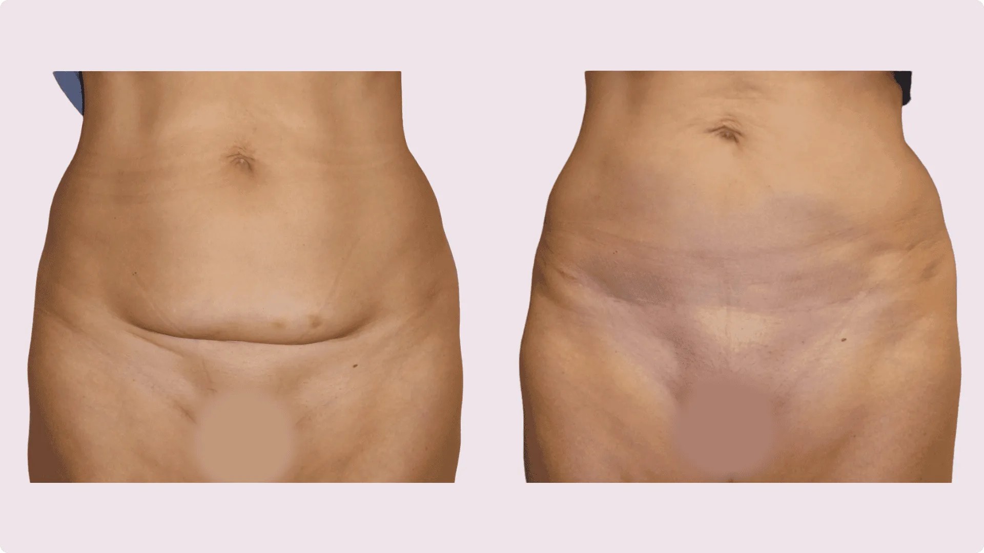 Tummy Tuck – Abdominoplasty – before and after photo 9