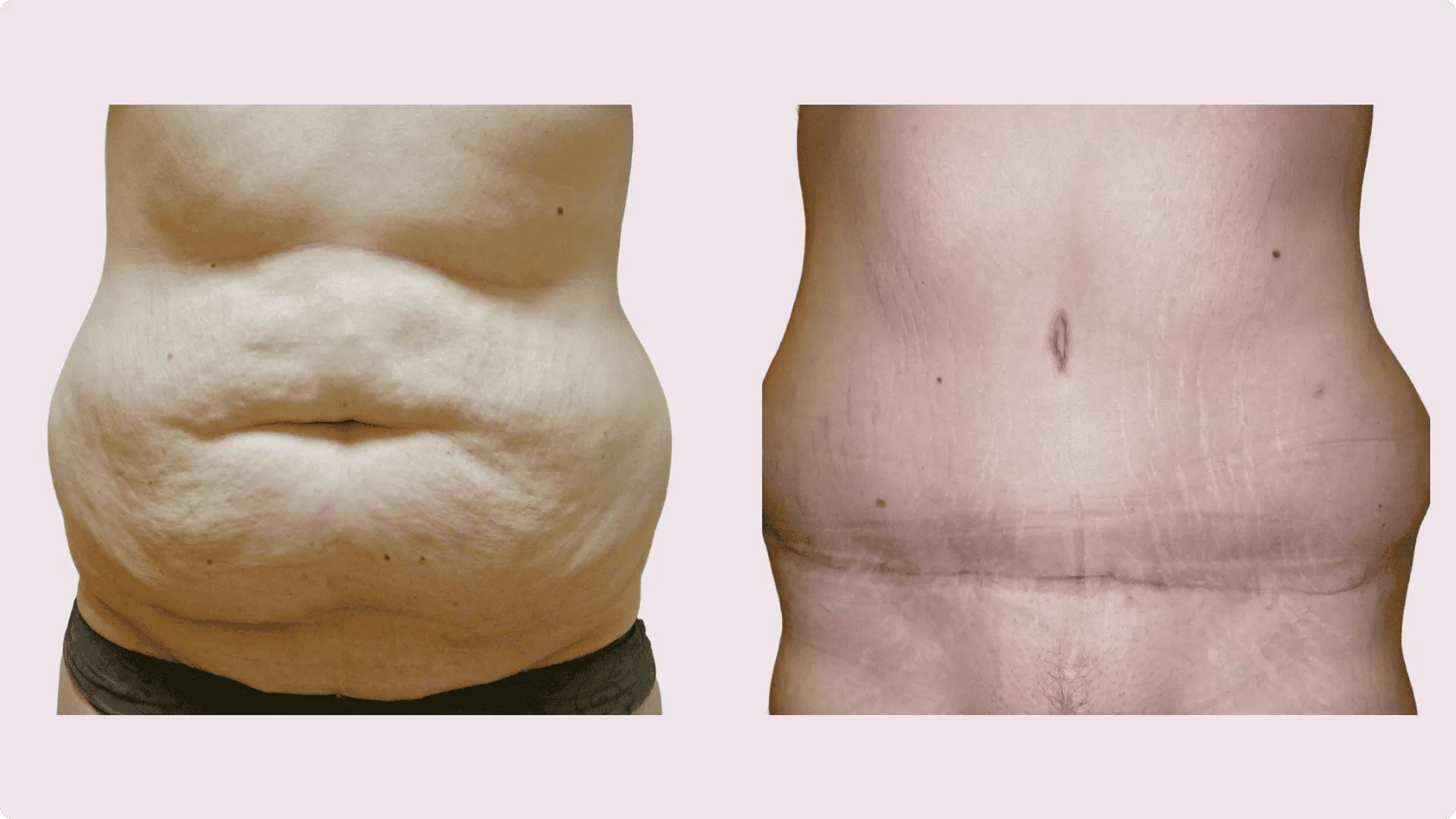Tummy Tuck – Abdominoplasty – before and after photo 10