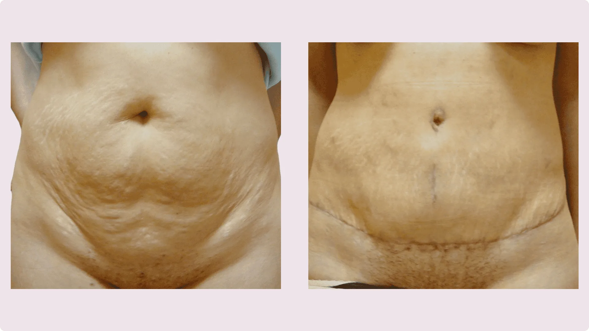 Tummy Tuck – Abdominoplasty – before and after photo 11