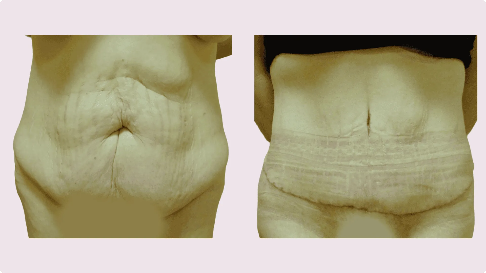 Tummy Tuck – Abdominoplasty – before and after photo 12