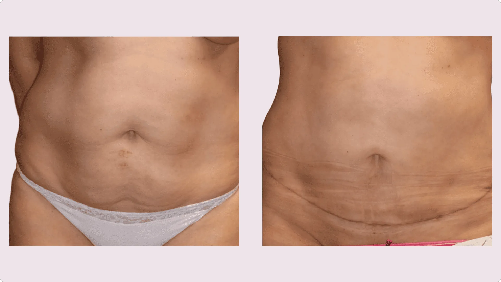Tummy Tuck – Abdominoplasty – before and after photo 13