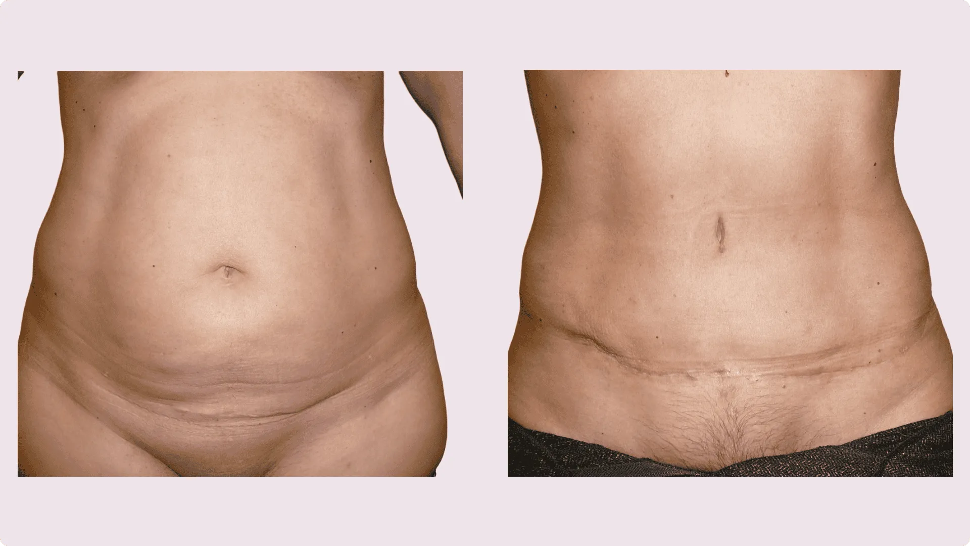 Tummy Tuck – Abdominoplasty – before and after photo 14