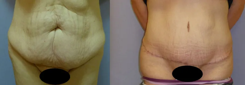 Абдомінопластика – результат 2