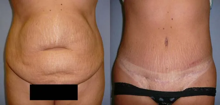 Абдомінопластика – результат 3