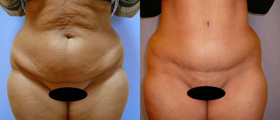 Абдомінопластика – результат 4
