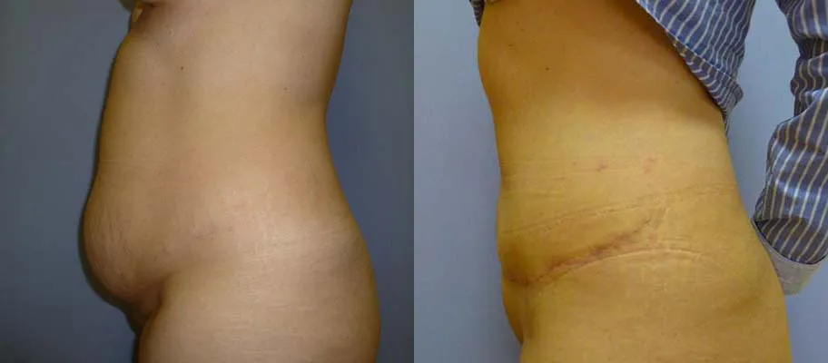 Пластика живота – Абдомінопластика – результат 5