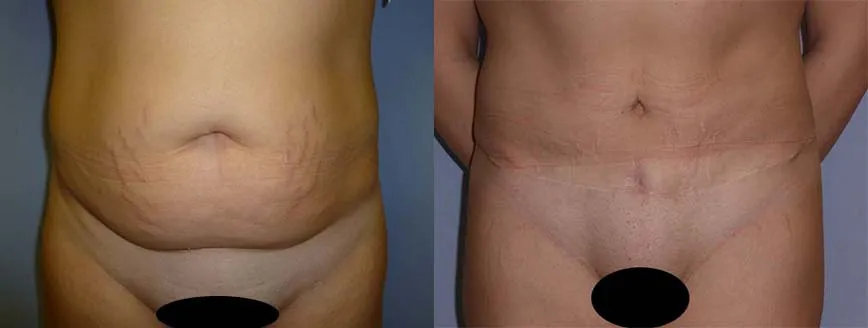 Абдомінопластика – результат 5