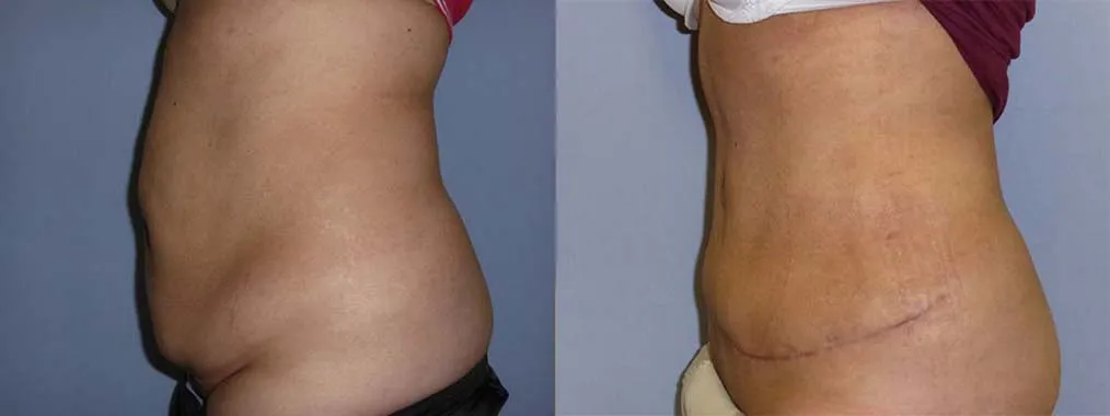 Пластика живота – Абдомінопластика – результат 7