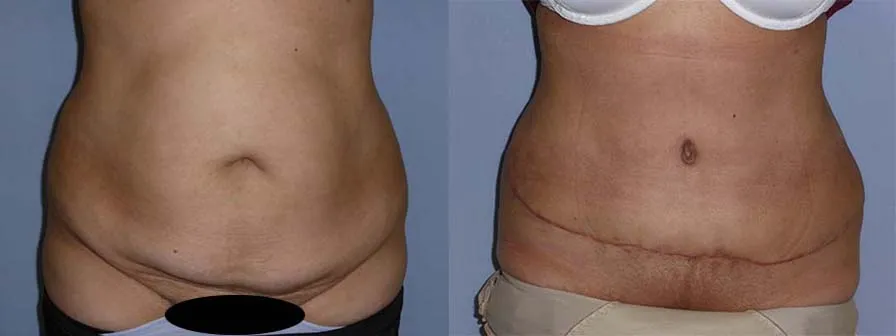Абдомінопластика – результат 6