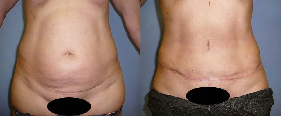 Пластика живота – Абдомінопластика – результат 9