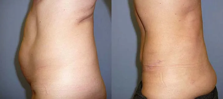Пластика живота – Абдомінопластика – результат 10