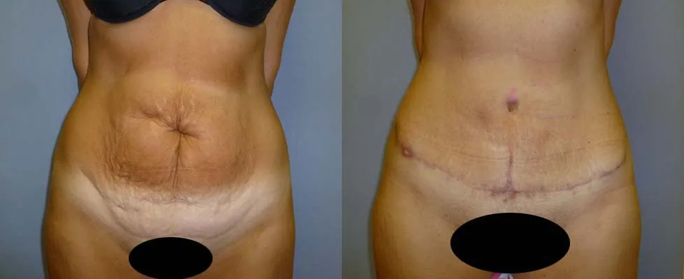 Пластика живота – Абдомінопластика – результат 11