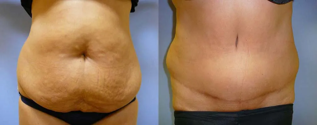 Пластика живота – Абдомінопластика – результат 13