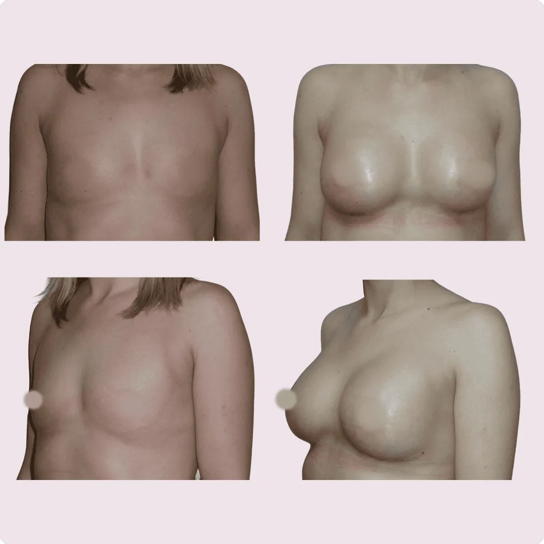 Zvětšení prsů – Augmentace – fotografie před a po 12