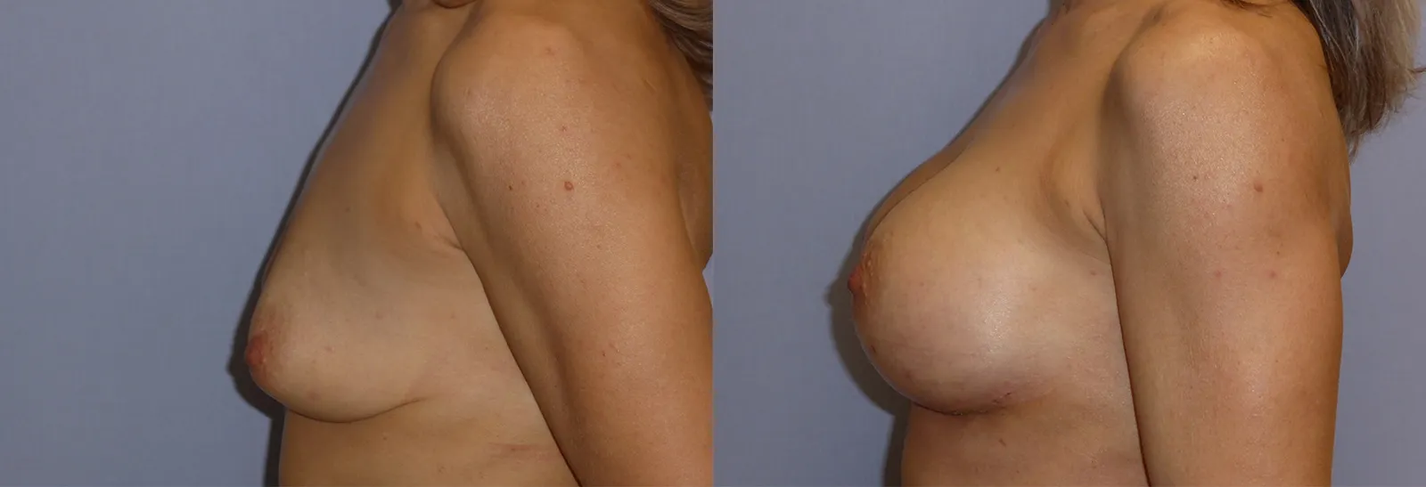 Збільшення грудей – Аугментація – результат 4