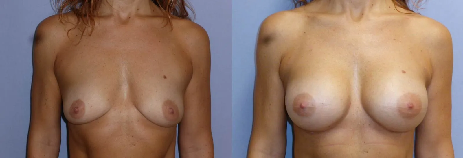 Збільшення грудей – Аугментація – результат 5