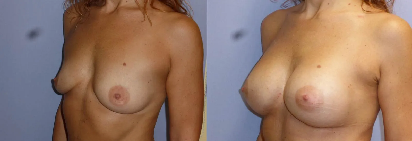 Збільшення грудей – Аугментація – результат 6