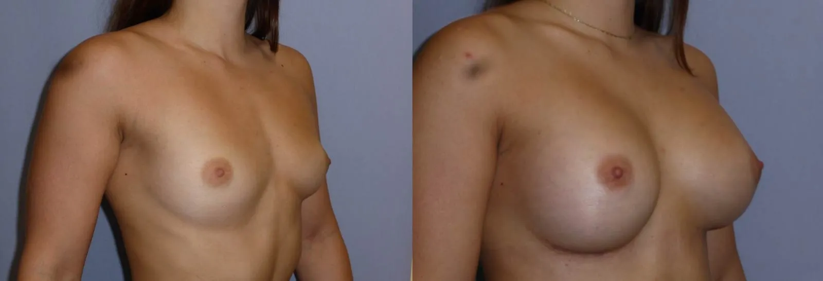 Збільшення грудей (Аугментація) – результат 2