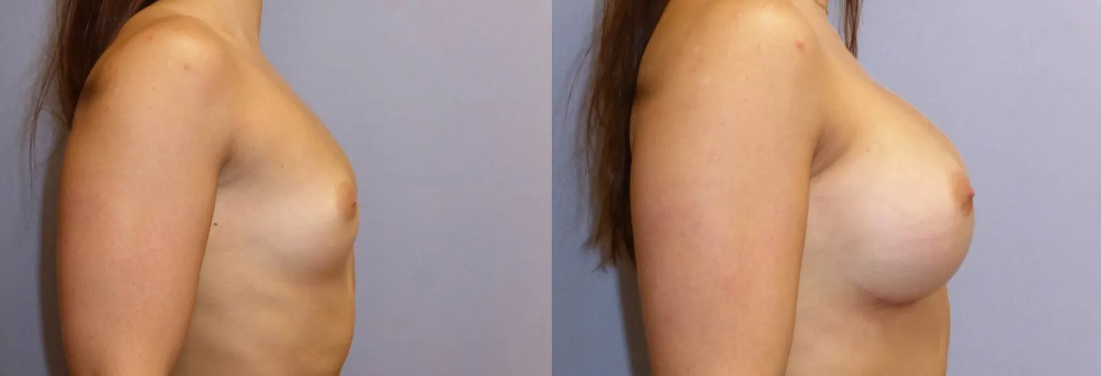 Збільшення грудей – Аугментація – результат 8