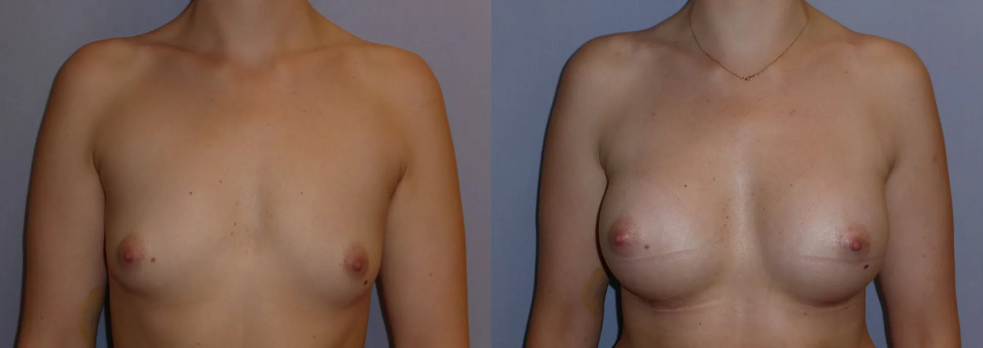 Збільшення грудей – Аугментація – результат 9