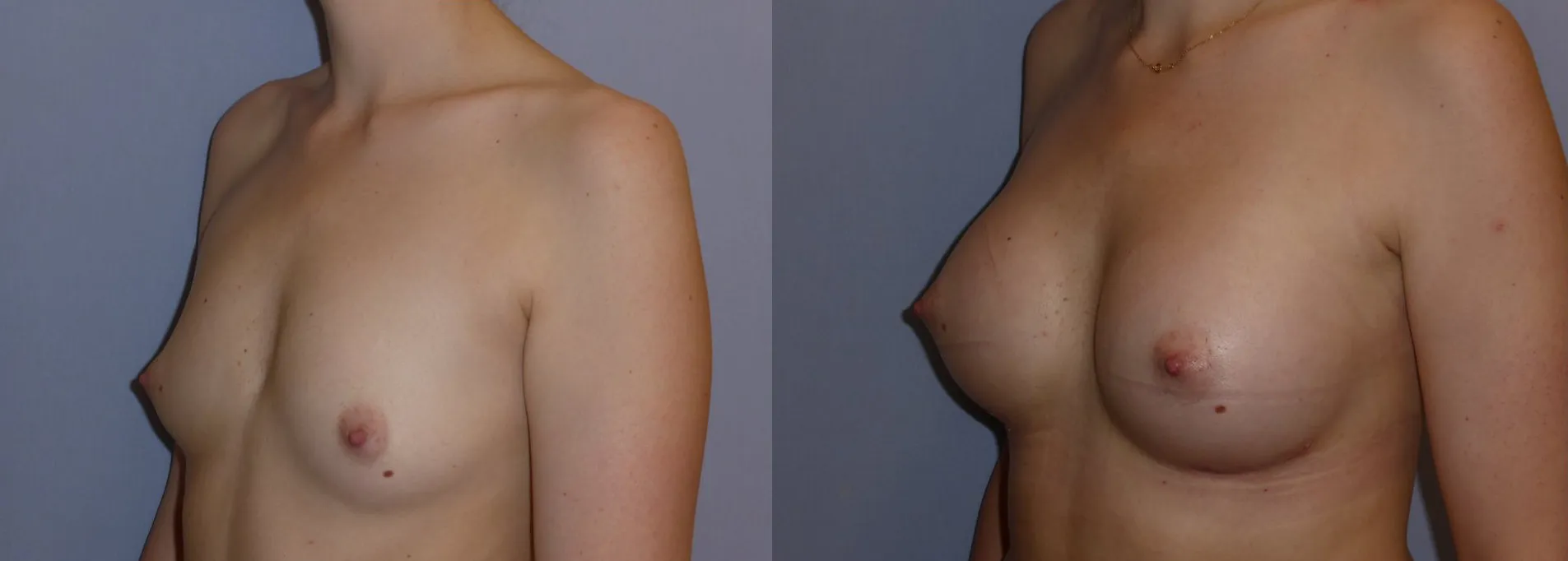 Збільшення грудей – Аугментація – результат 10