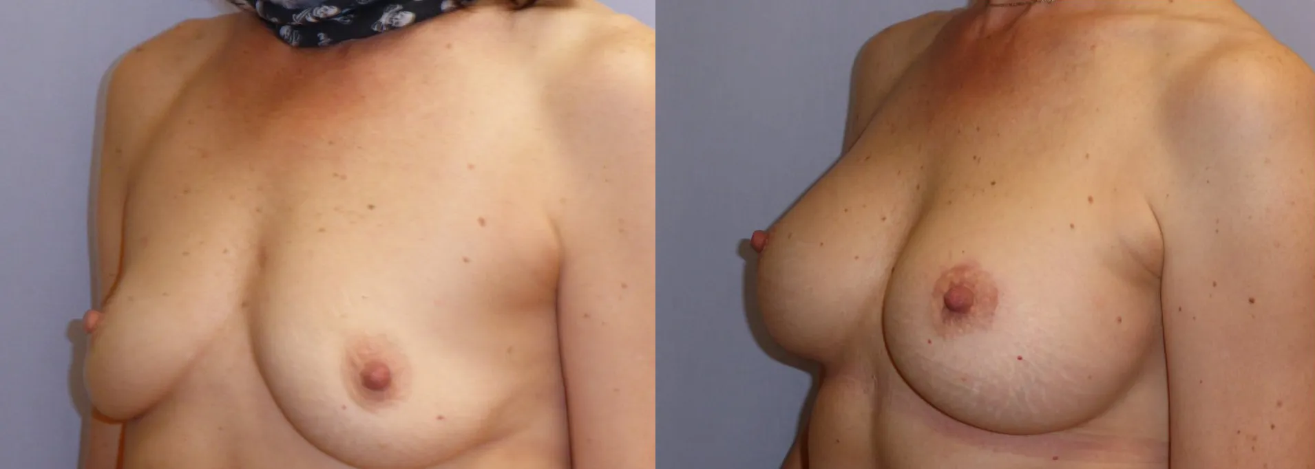 Збільшення грудей – Аугментація – результат 12