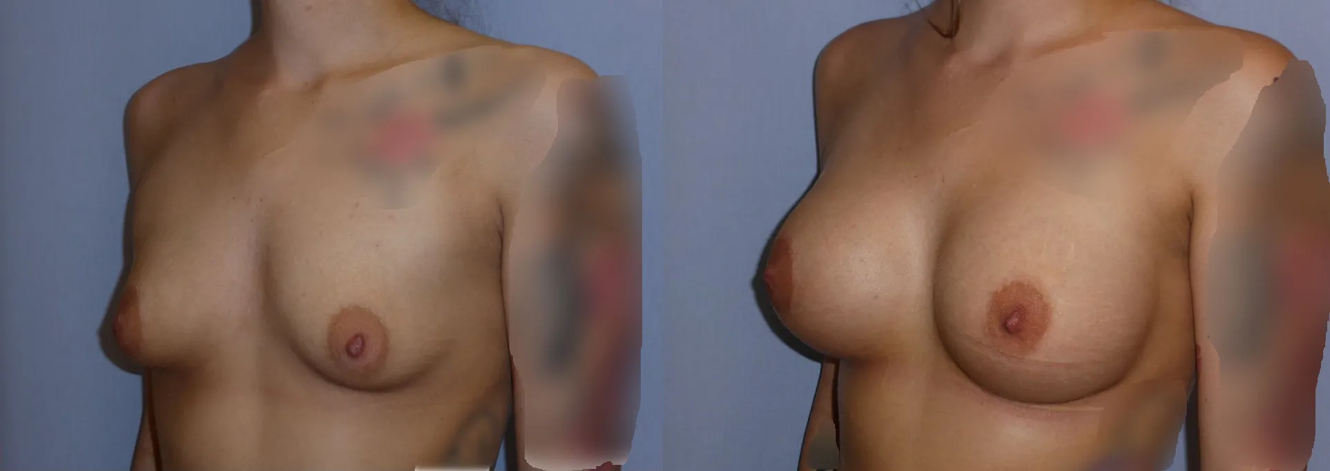 Збільшення грудей – Аугментація – результат 15