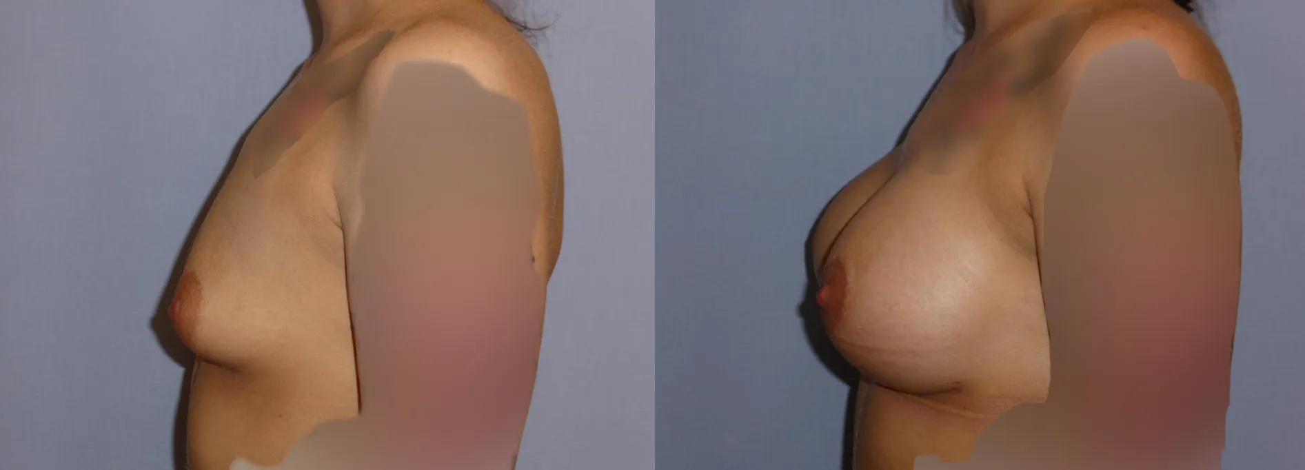 Збільшення грудей (Аугментація) – результат 3