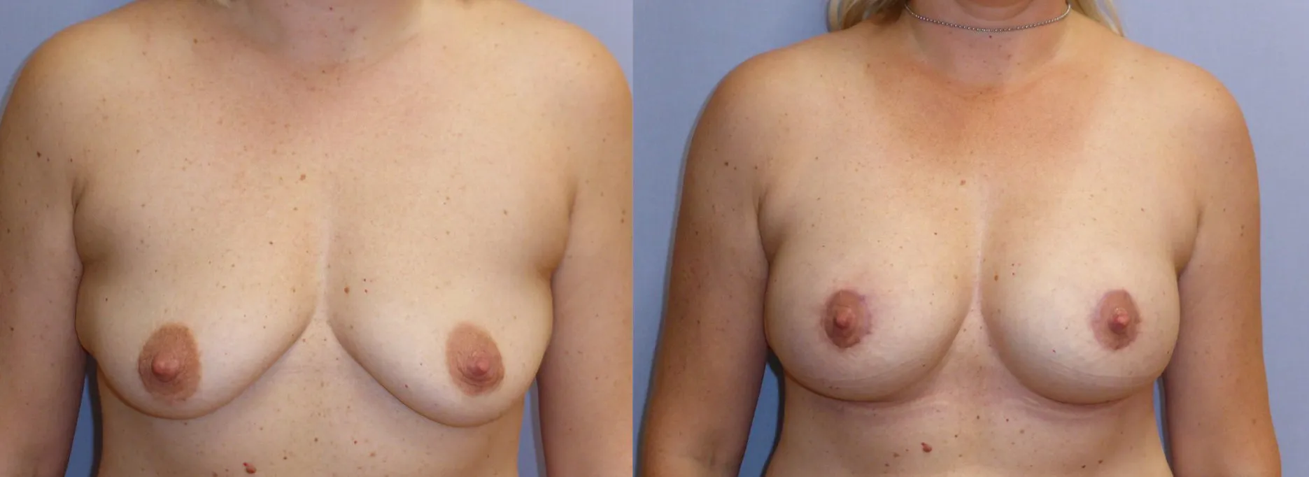 Збільшення грудей – Аугментація – результат 17