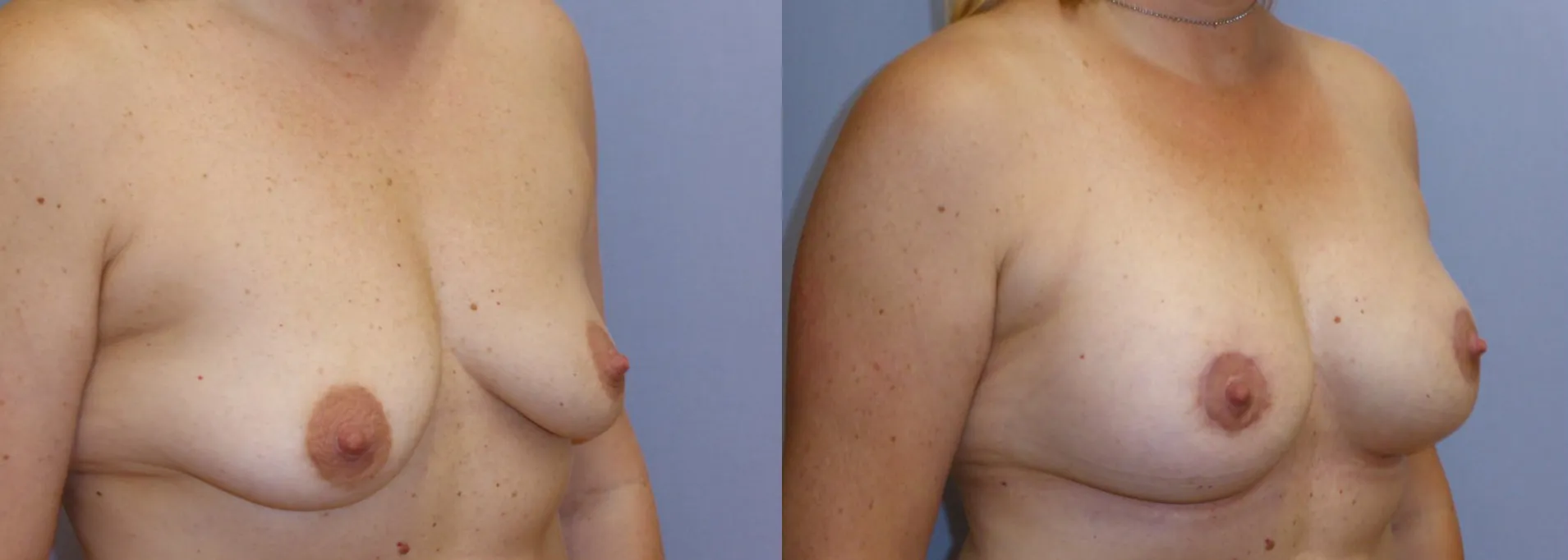 Збільшення грудей – Аугментація – результат 18