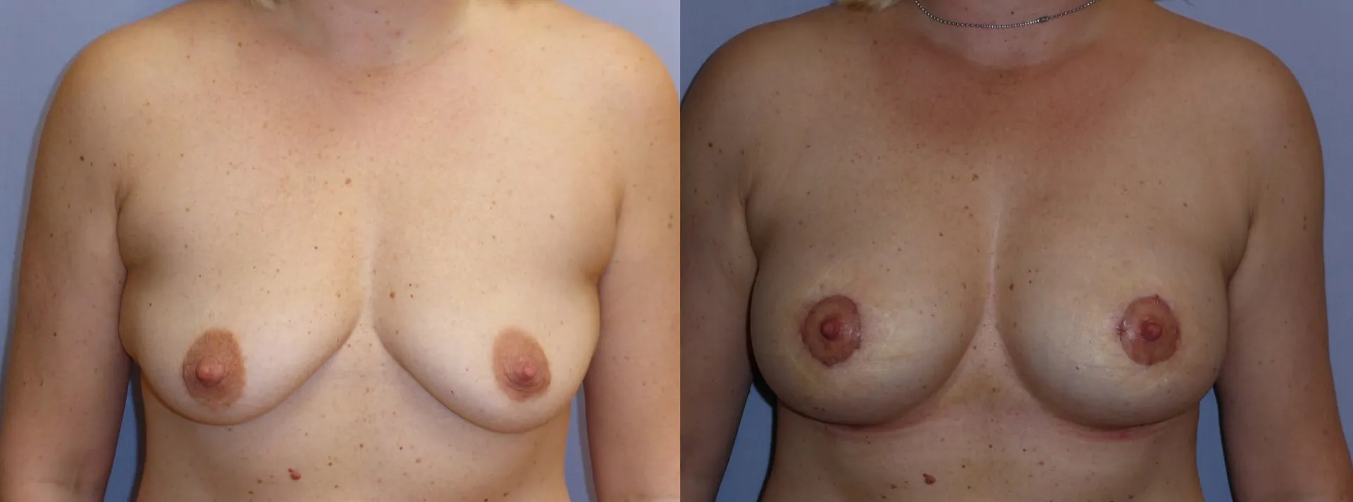 Збільшення грудей – Аугментація – результат 19