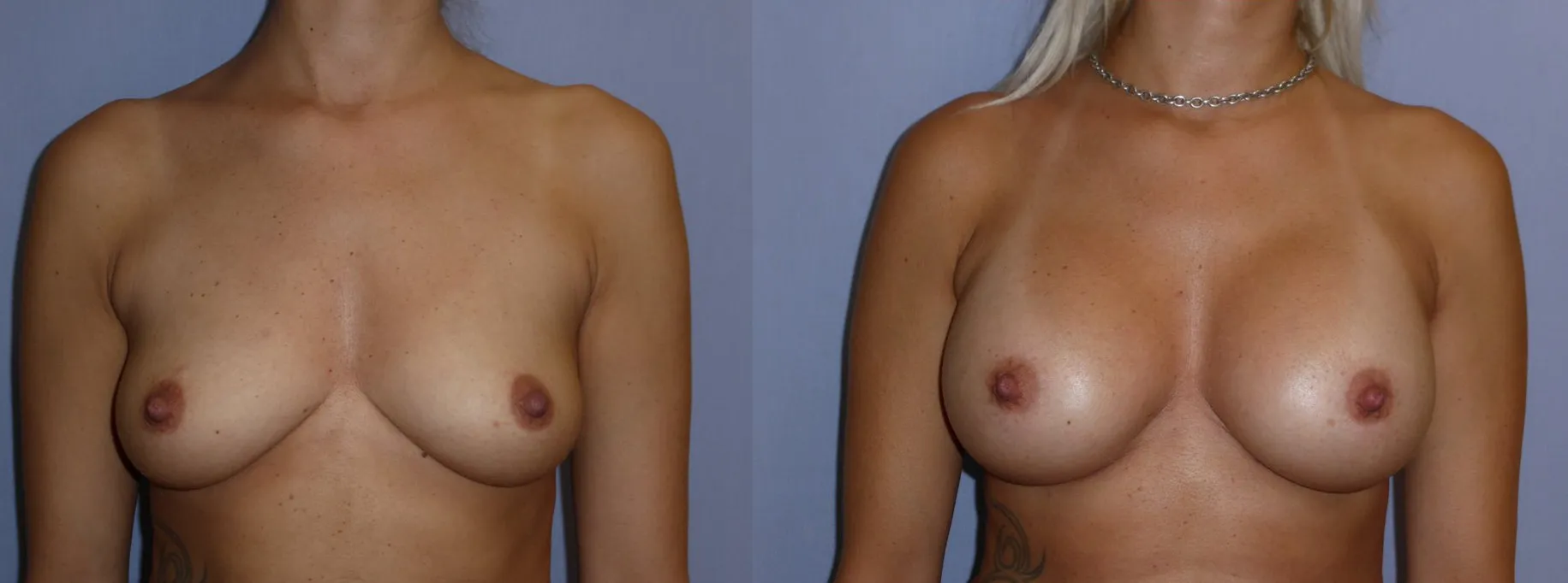 Збільшення грудей – Аугментація – результат 20