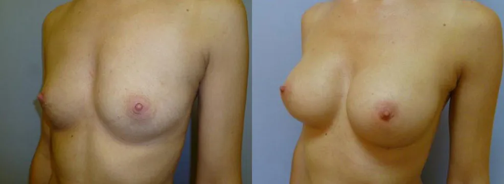 Збільшення грудей – Аугментація – результат 22