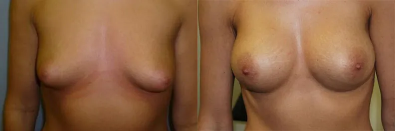Збільшення грудей – Аугментація – результат 23