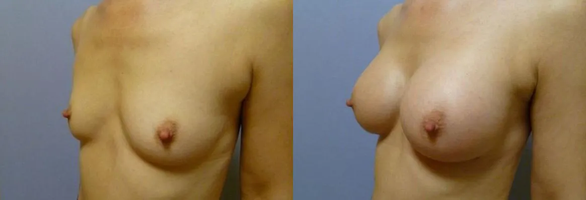 Збільшення грудей – Аугментація – результат 24