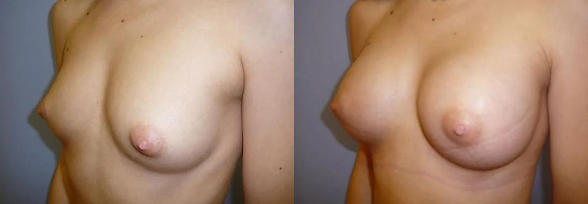 Збільшення грудей (Аугментація) – результат 4